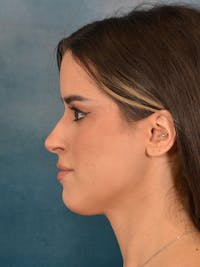 Rhinoplasty Before & After Gallery - Patient 267492 - Image 1