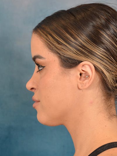 Rhinoplasty Before & After Gallery - Patient 267492 - Image 2