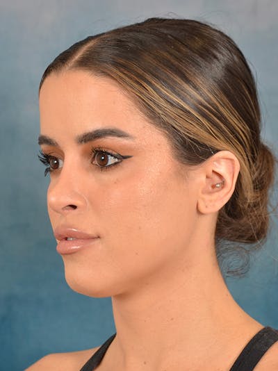 Rhinoplasty Before & After Gallery - Patient 267492 - Image 4