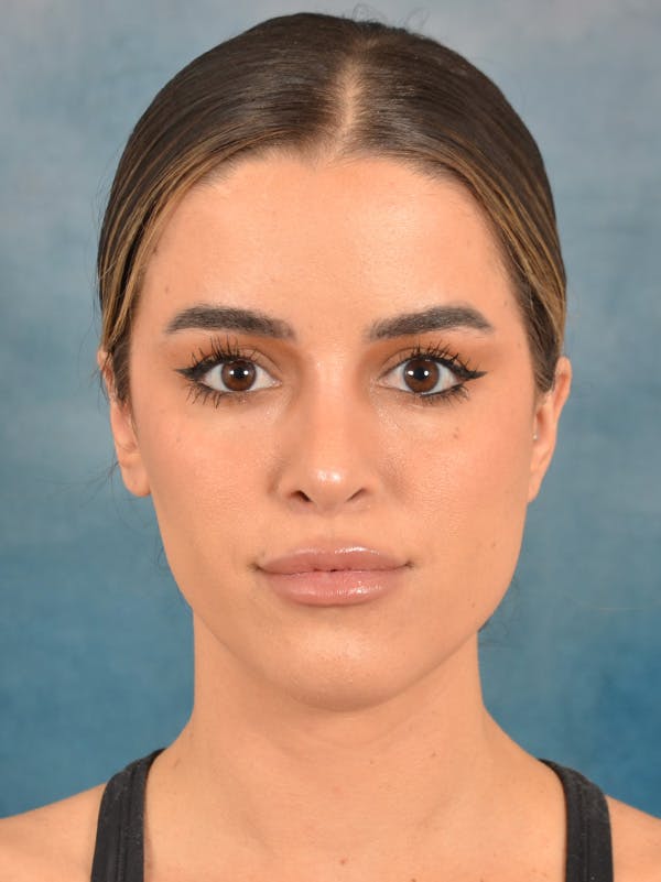 Rhinoplasty Before & After Gallery - Patient 267492 - Image 6