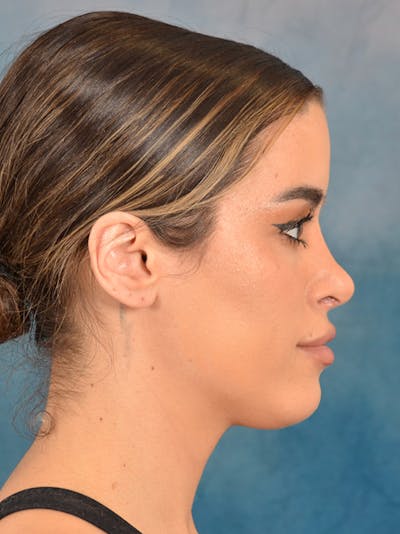 Rhinoplasty Before & After Gallery - Patient 267492 - Image 10