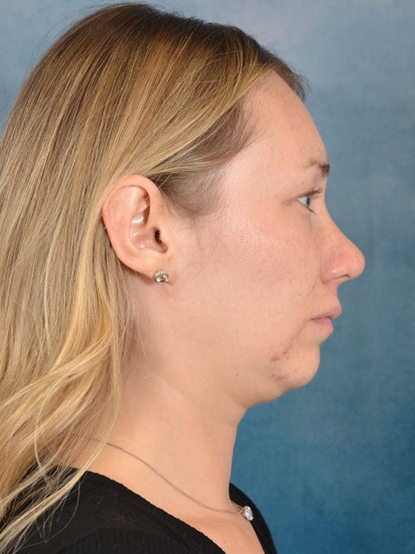 Rhinoplasty Before & After Gallery - Patient 198551 - Image 10