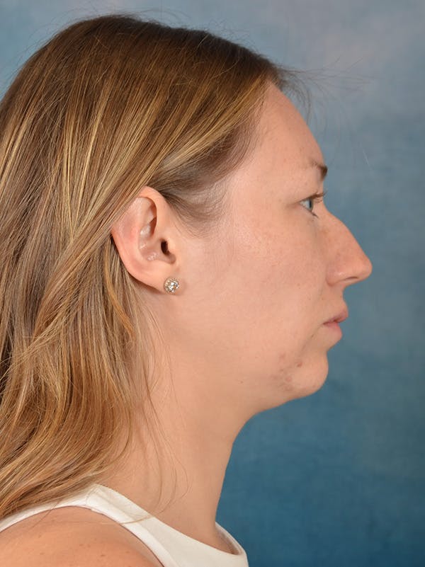Rhinoplasty Before & After Gallery - Patient 198551 - Image 9