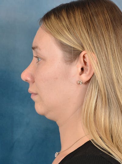 Rhinoplasty Before & After Gallery - Patient 198551 - Image 2