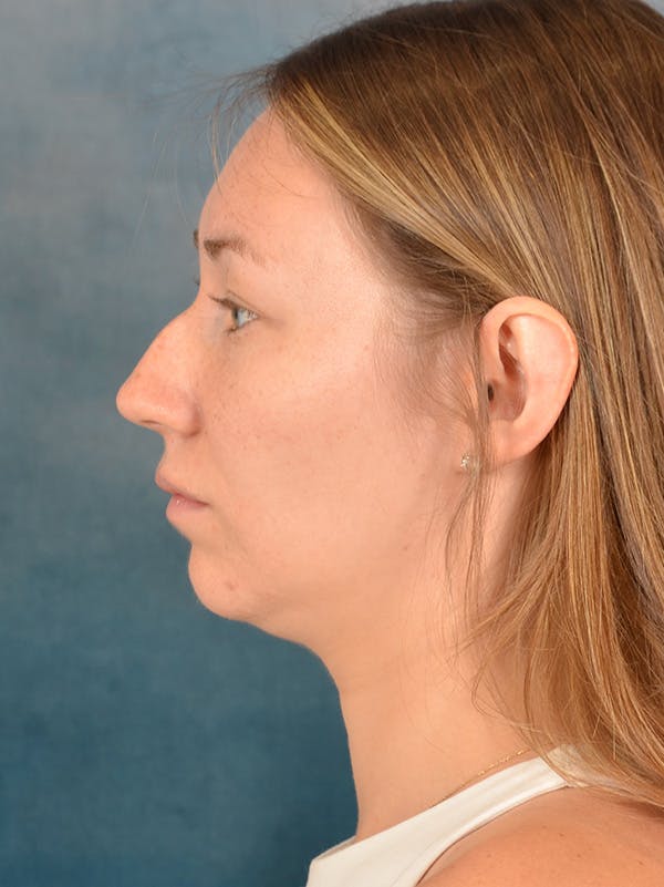 Rhinoplasty Before & After Gallery - Patient 198551 - Image 1