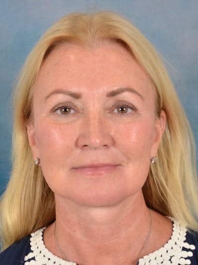 Deep Plane Facelift Before & After Gallery - Patient 239524 - Image 4