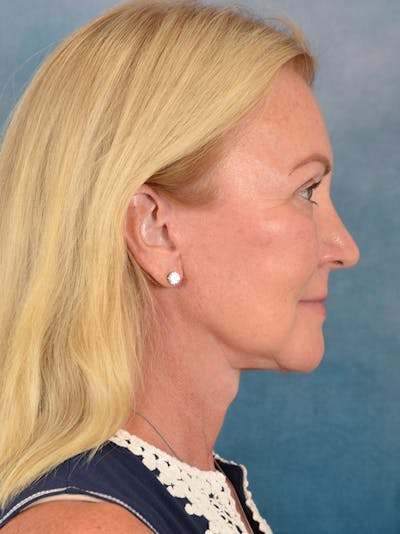 Deep Plane Facelift Before & After Gallery - Patient 239524 - Image 8