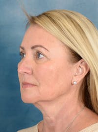 Deep Plane Facelift Before & After Gallery - Patient 239524 - Image 1