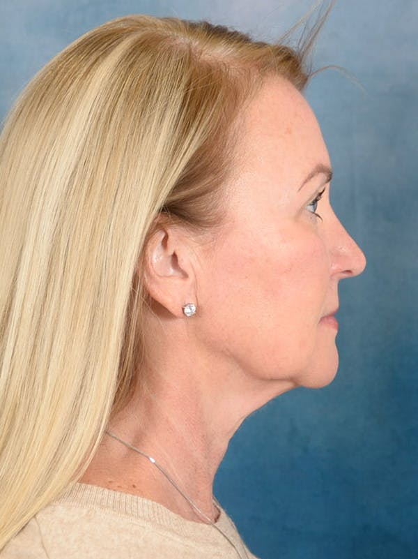 Deep Plane Facelift Before & After Gallery - Patient 239524 - Image 7