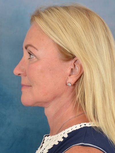 Deep Plane Facelift Before & After Gallery - Patient 239524 - Image 10