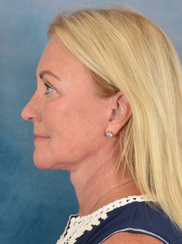 Deep Plane Facelift Before & After Gallery - Patient 239524 - Image 10