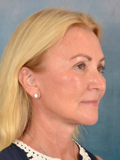 Deep Plane Facelift Before & After Gallery - Patient 239524 - Image 6