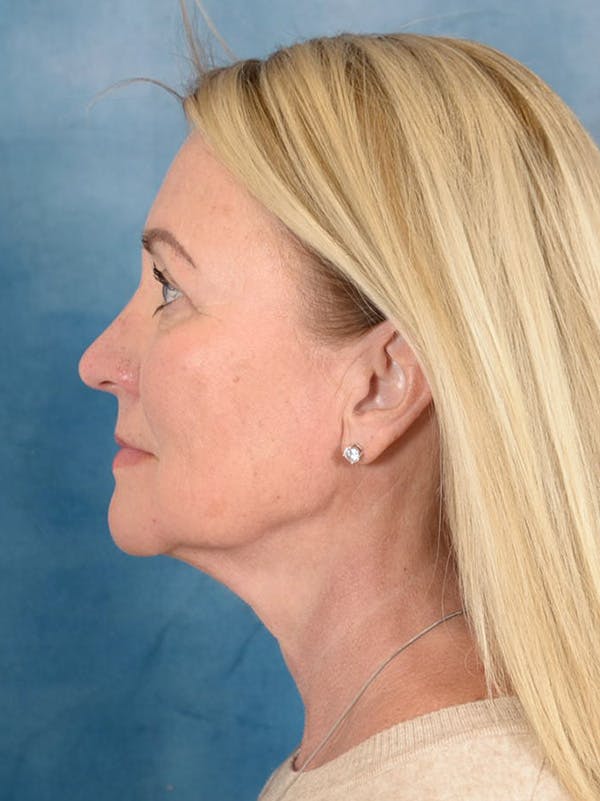 Deep Plane Facelift Before & After Gallery - Patient 239524 - Image 9