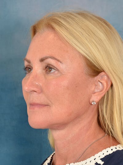 Deep Plane Facelift Before & After Gallery - Patient 239524 - Image 2