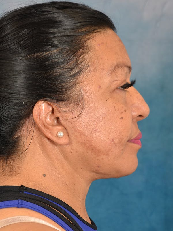 Deep Plane Facelift Before & After Gallery - Patient 420710 - Image 8