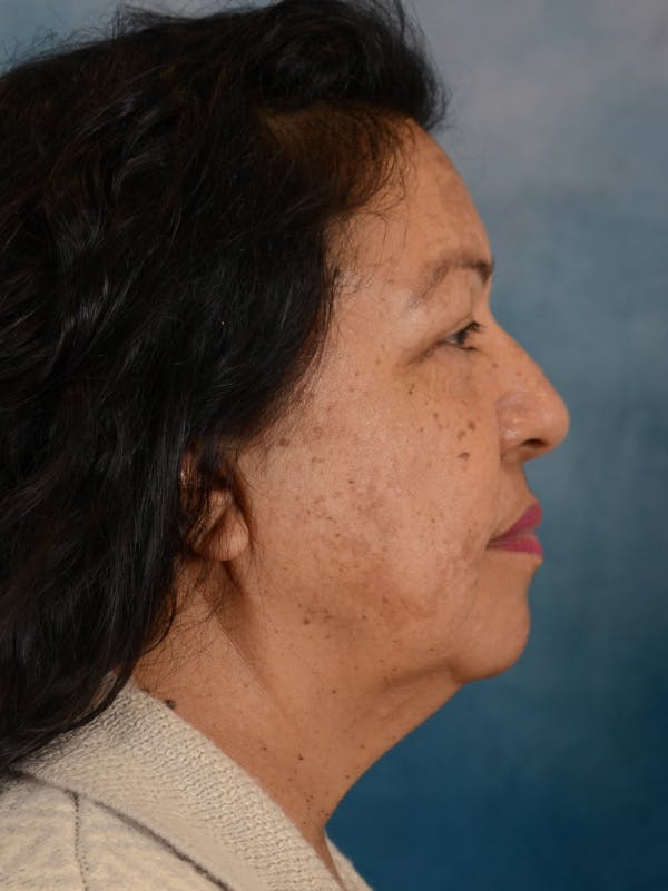 Deep Plane Facelift Before & After Gallery - Patient 420710 - Image 7