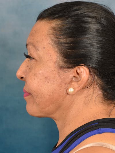 Deep Plane Facelift Before & After Gallery - Patient 420710 - Image 10