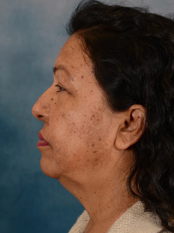Deep Plane Facelift Before & After Gallery - Patient 420710 - Image 9