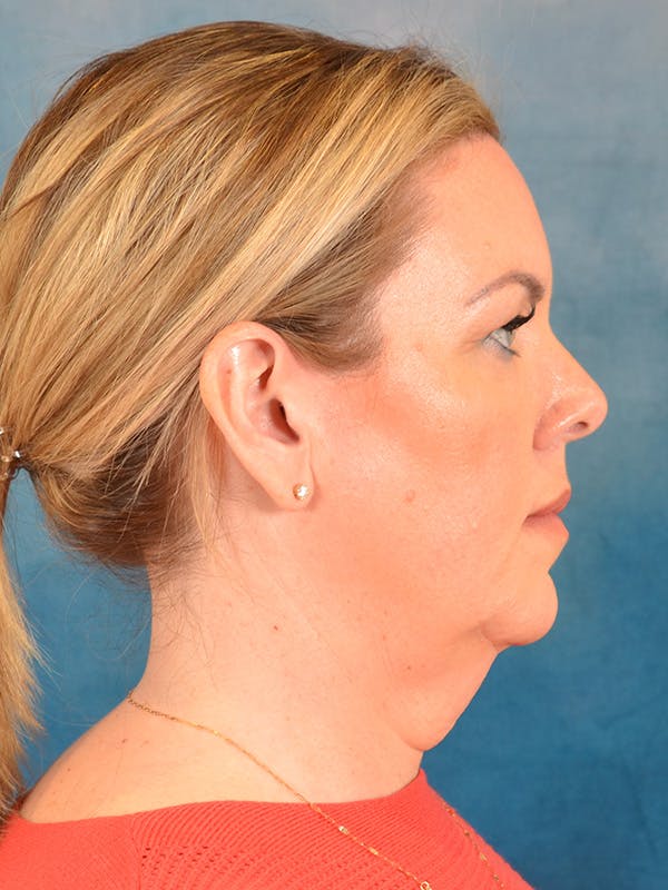 Deep Neck Lift Before & After Gallery - Patient 337109 - Image 7