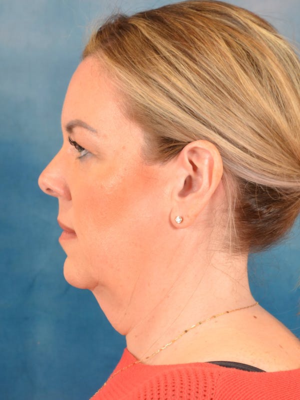 Deep Plane Facelift Before & After Gallery - Patient 204161 - Image 9