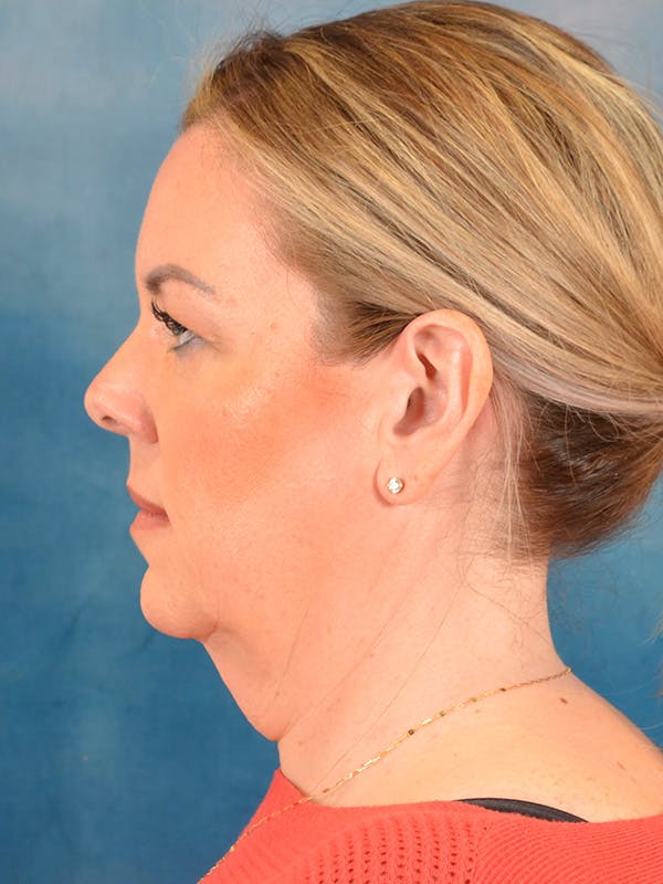 Deep Neck Lift Before & After Gallery - Patient 337109 - Image 9