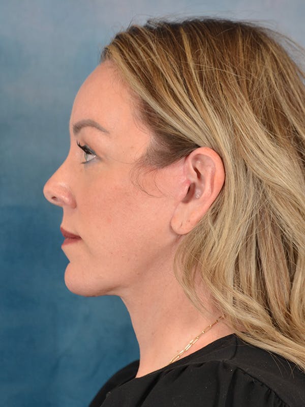 Deep Neck Lift Before & After Gallery - Patient 337109 - Image 10