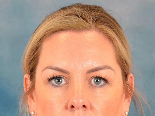 Brow Lift Before & After Gallery - Patient 282122 - Image 1