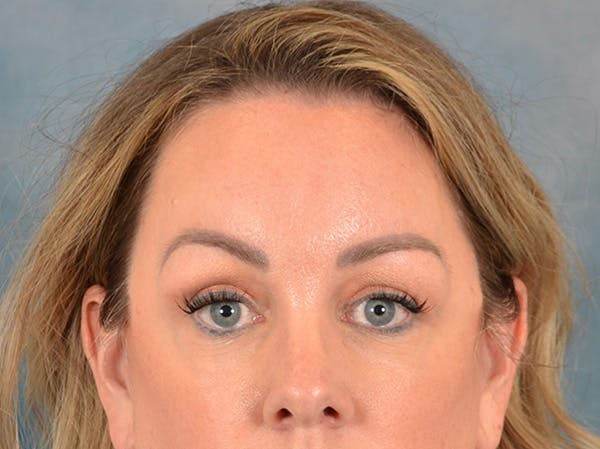 Brow Lift Before & After Gallery - Patient 282122 - Image 2