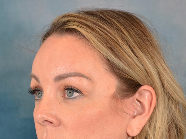 Brow Lift Before & After Gallery - Patient 282122 - Image 8