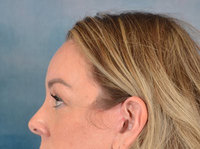 Brow Lift Before & After Gallery - Patient 282122 - Image 10