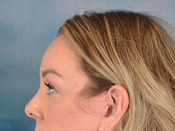 Brow Lift Before & After Gallery - Patient 282122 - Image 10