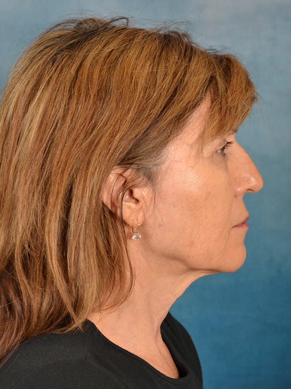 Deep Neck Lift Before & After Gallery - Patient 417771 - Image 7