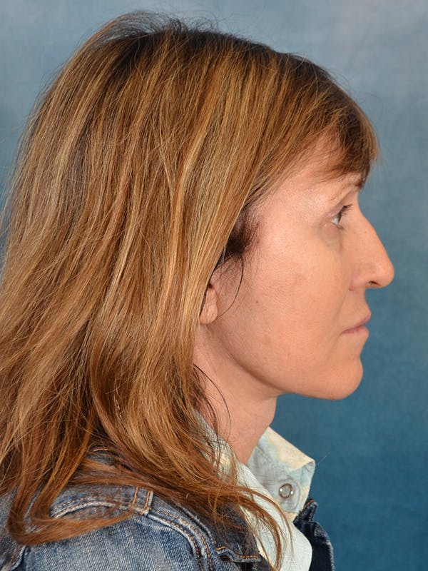 Deep Neck Lift Before & After Gallery - Patient 417771 - Image 8