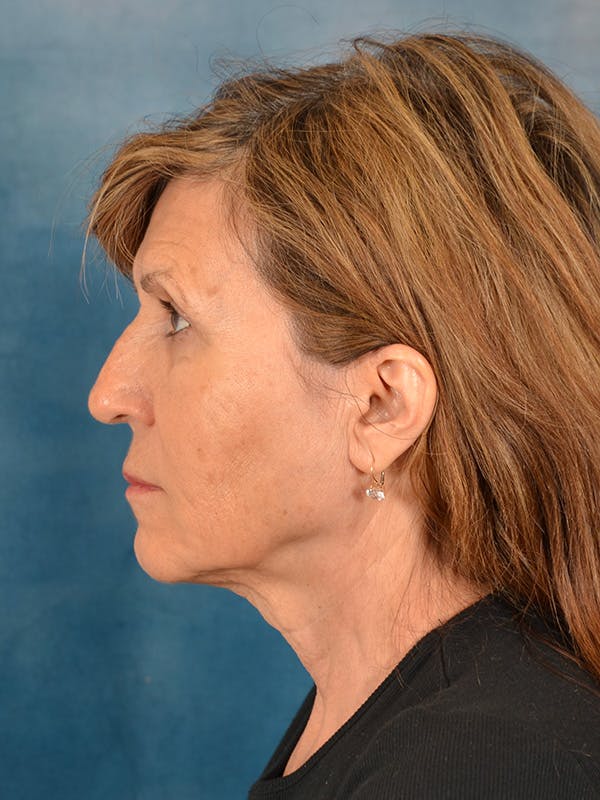 Deep Neck Lift Before & After Gallery - Patient 417771 - Image 9