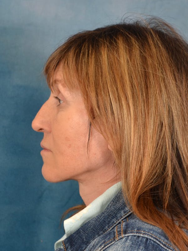 Deep Neck Lift Before & After Gallery - Patient 417771 - Image 10
