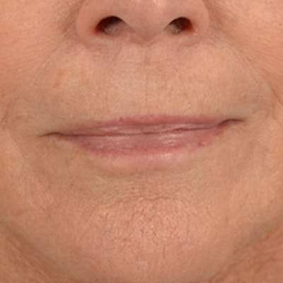 Lip Lift Before & After Gallery - Patient 146208695 - Image 2