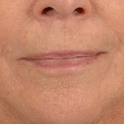 Lip Lift Before & After Gallery - Patient 146208695 - Image 2