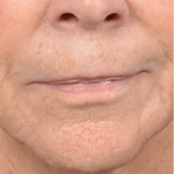 Lip Lift Before & After Gallery - Patient 146208695 - Image 1