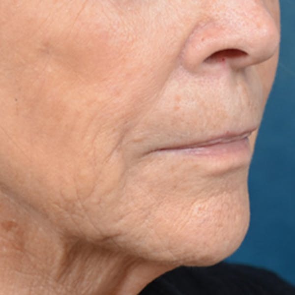 Lip Lift Before & After Gallery - Patient 146208695 - Image 3