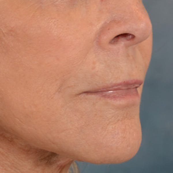 Lip Lift Before & After Gallery - Patient 146208695 - Image 4