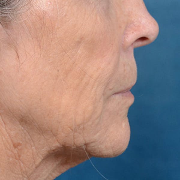 Lip Lift Before & After Gallery - Patient 146208695 - Image 5