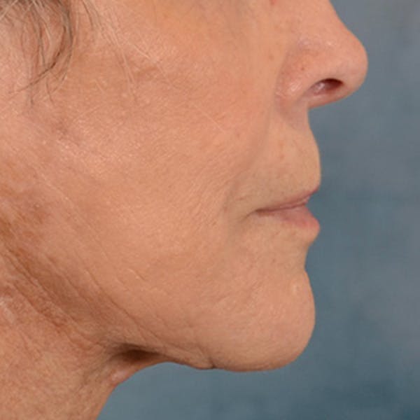 Lip Lift Before & After Gallery - Patient 146208695 - Image 6