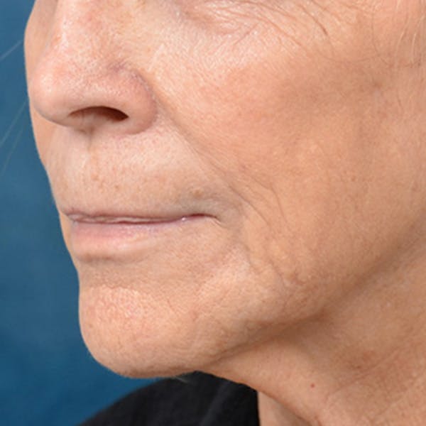 Lip Lift Before & After Gallery - Patient 146208695 - Image 7