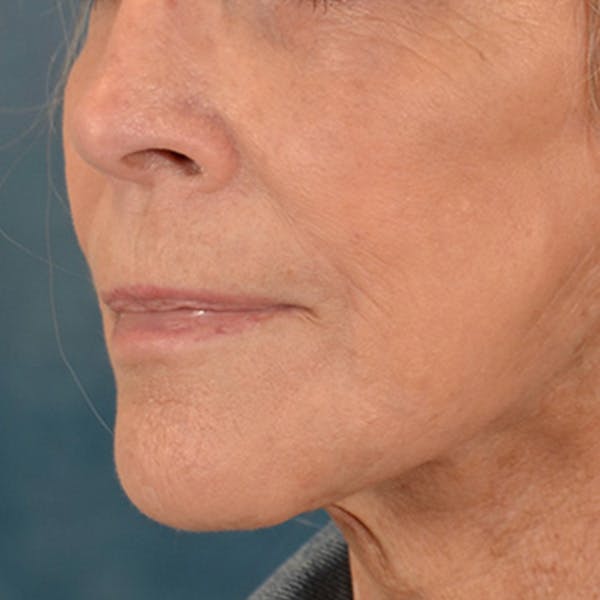 Lip Lift Before & After Gallery - Patient 146208695 - Image 8