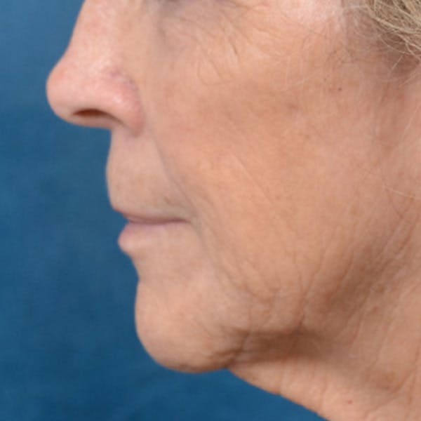 Lip Lift Before & After Gallery - Patient 146208695 - Image 9