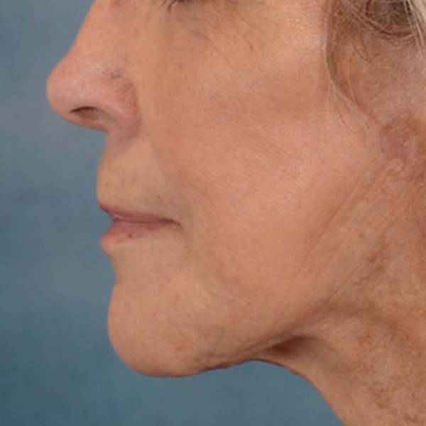 Lip Lift Before & After Gallery - Patient 146208695 - Image 10