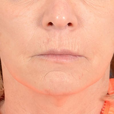 Lip Lift Before & After Gallery - Patient 169365984 - Image 1