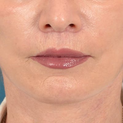 Lip Lift Before & After Gallery - Patient 169365984 - Image 2
