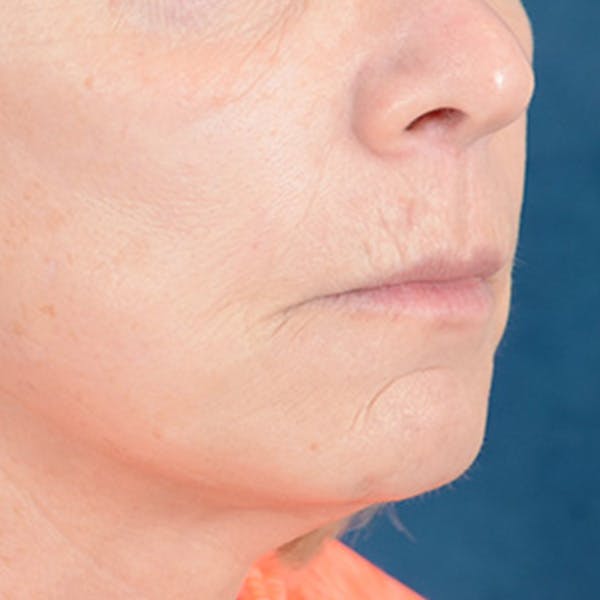 Lip Lift Before & After Gallery - Patient 169365984 - Image 3