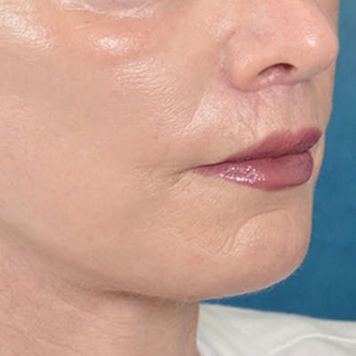 Lip Lift Before & After Gallery - Patient 169365984 - Image 4
